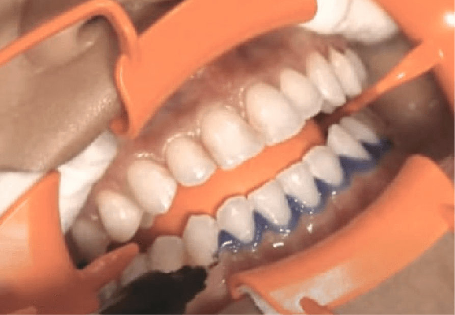 開口器の装着＆歯肉保護