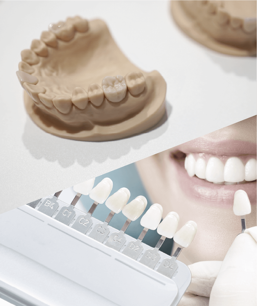 セラミック治療イメージ