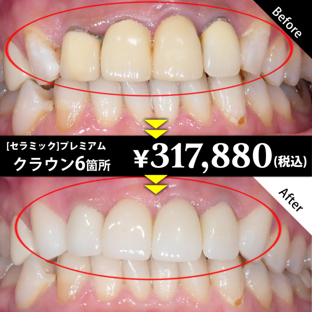 [セラミック]プレミアム クラウン6箇所 ￥317,880（税込）