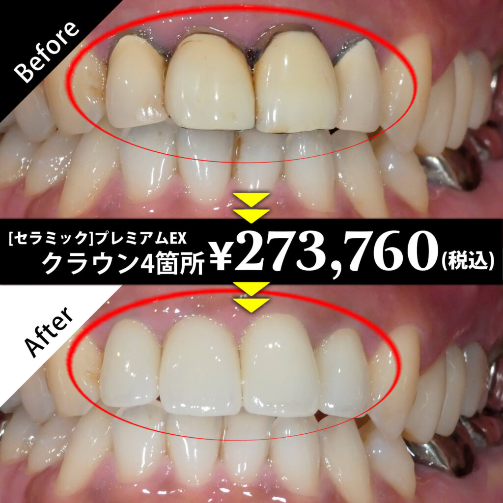[セラミック]プレミアムEX クラウン4箇所 ￥273,760（税込）