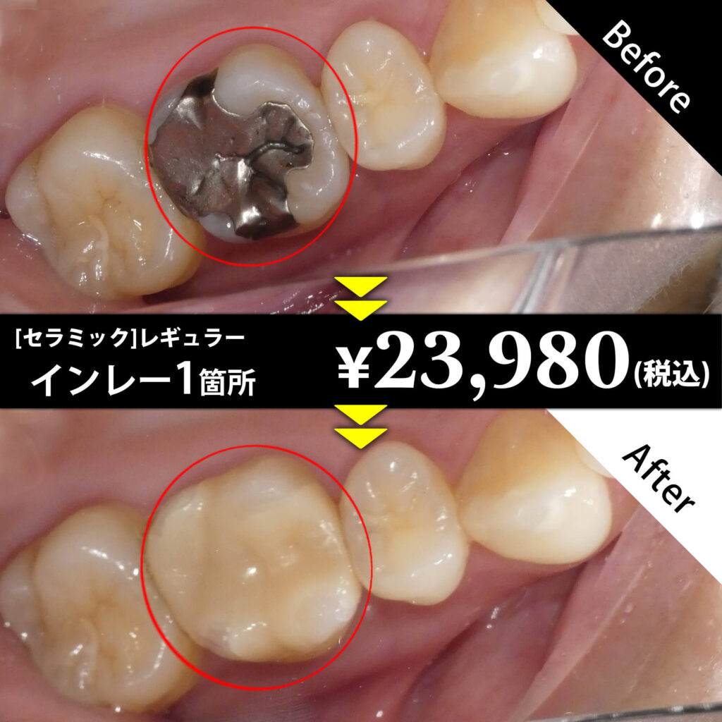 [セラミック]レギュラー インレー1箇所 ￥23,980（税込）