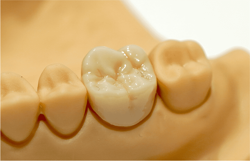 フルジルコニア