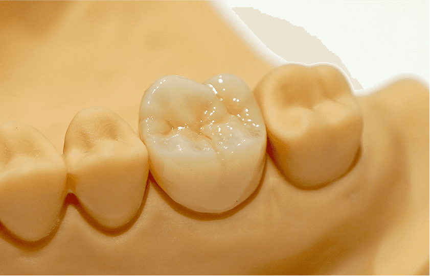 ジルコニアステイン